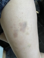 Itching and bruising