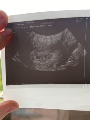 Faint yolk sac 5 days 3