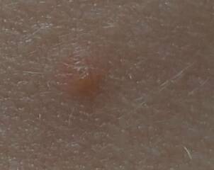 Chickenpox?