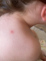 Recurring spots/rash on child