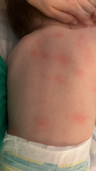 Heat rash or ?