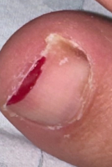 Photo warning Fungal toenail or subungual melanoma? HeLp!!