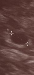 5+3 Ultrasound - gestational sac, chorion, potentially no yolk sac??