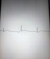 Can anyone have a look at this EKG??