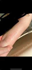 This rash on 3 year old