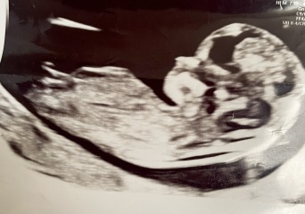 Gender guesses - 12 week scan