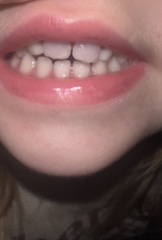 Can a grey baby tooth go white again after trauma?