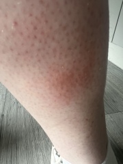 Help identify bites!