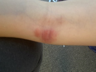 Any Relief for eczema ?! (Pics included)