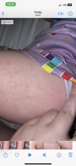 Help. Daughters come out in a rash