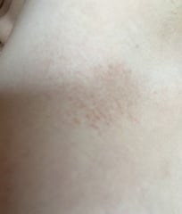 Discolour/ rash?