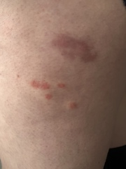 Help identify bites!