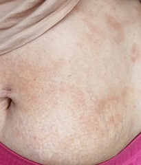 What is this rash on my stomach? Photos attached