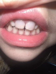 Can a grey baby tooth go white again after trauma?