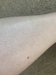 Strawberry legs and general bad skin all over - help!