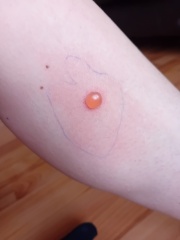 What has bitten me? Warning: pic's included