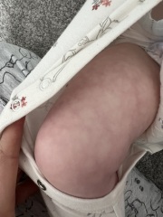 Badly mottled skin 1 year old