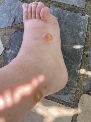 What has bitten me? Warning: pic's included