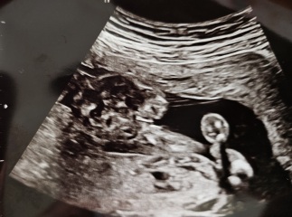 Told boy at 15 weeks and girl at 20 week scan