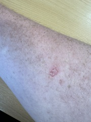 Dodgy skin patch - would this worry you!?