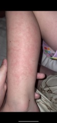 Help. Daughters come out in a rash