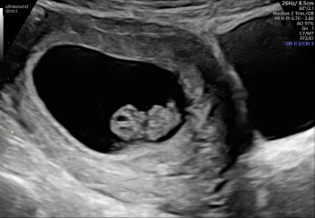 Can I see your 8-10 weeks scans