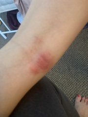 Any Relief for eczema ?! (Pics included)