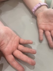 parvovirus