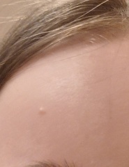 What is this on my sons face?