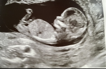 Gender guesses - 12 week scan