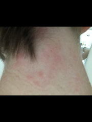 Does this look like shingles?