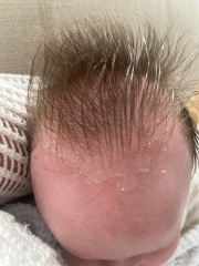 Is this cradle cap?