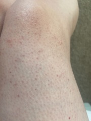 Strawberry legs and general bad skin all over - help!