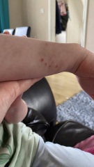 Dog bite