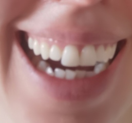 Bad teeth?!