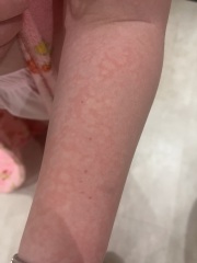 To take DD to the doctor for this rash