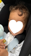 Is this a large forehead/frontal bossing?