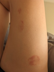 Anyone had a rash