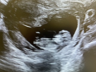 11 week scan - nub theory 