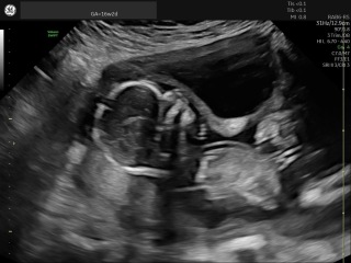 Can anyone tell which placenta variation this is?