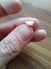 Losing milk teeth at 4