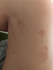 Anyone had a rash