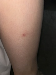 Mysterious bites, any advice please(with photos)