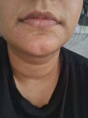 Dry skin around mouth and nose pics attached - what could be causing it?