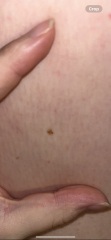 Would you be worried about this freckle/mole?
