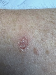 Dodgy skin patch - would this worry you!?
