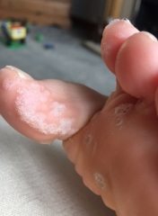 LOTS of verrucas for you