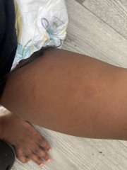 What could these bruises or dark marks be on child skin