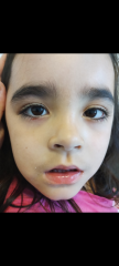 Toddler with chalazion on eye (picture)