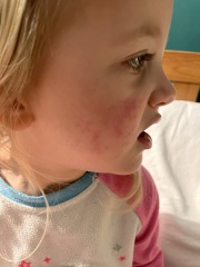 Slapped cheek syndrome?